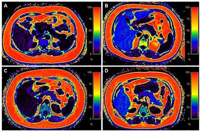 Corrigendum: Exploring the heterogeneity of hepatic and pancreatic fat deposition in obesity: implications for metabolic health